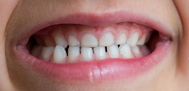 Child's Teeth