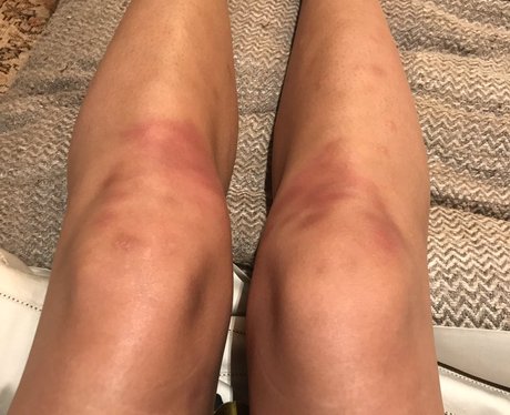 A 'Work Hazard' Leaves Chrissy Tiegan's Legs Bruis