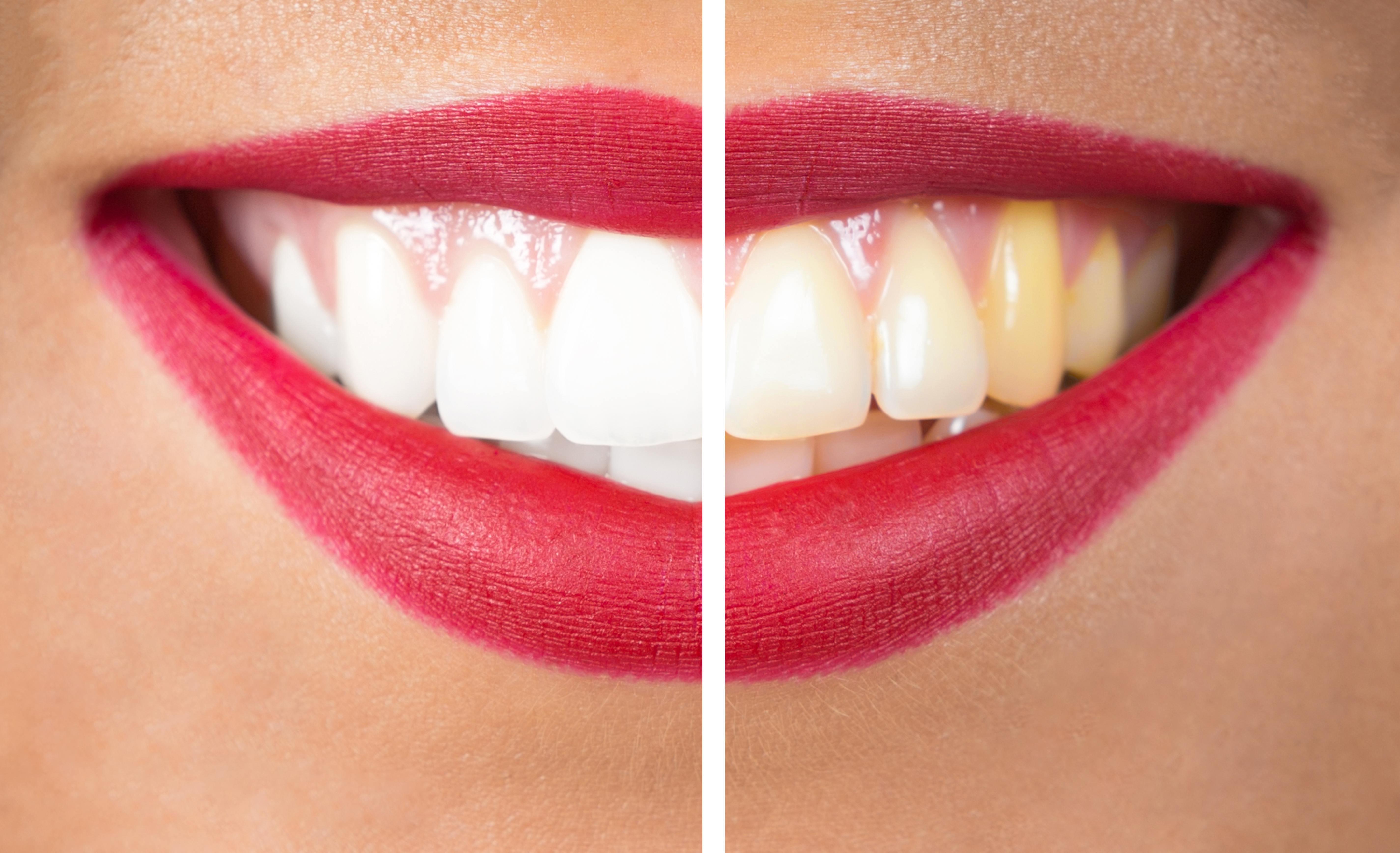 Teeth Whitening Solution - Look 10 Years Younger With A Whiter Smile