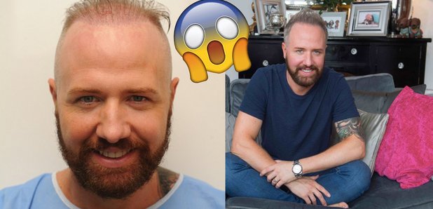 Gogglebox Chris Steed Hair Transplant