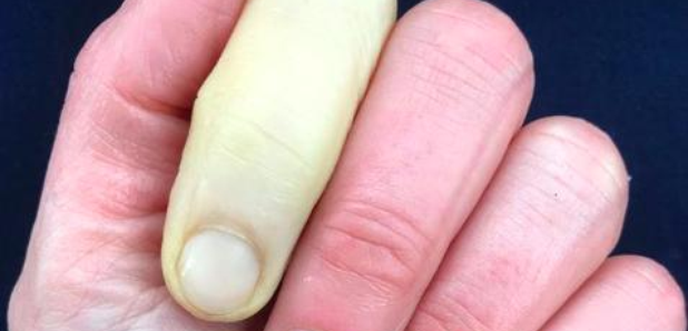 Ouch! Which celebrity has shared their battle with Raynaud's disease ...