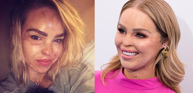 model katie piper acid attack