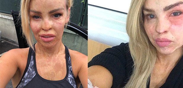 Who Is Katie Piper S Acid Attacker And How Did He Know Her Crime Details And Prison Release Date