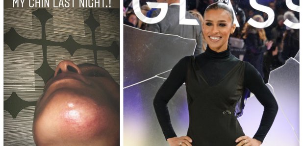 Melody Thornton Injury