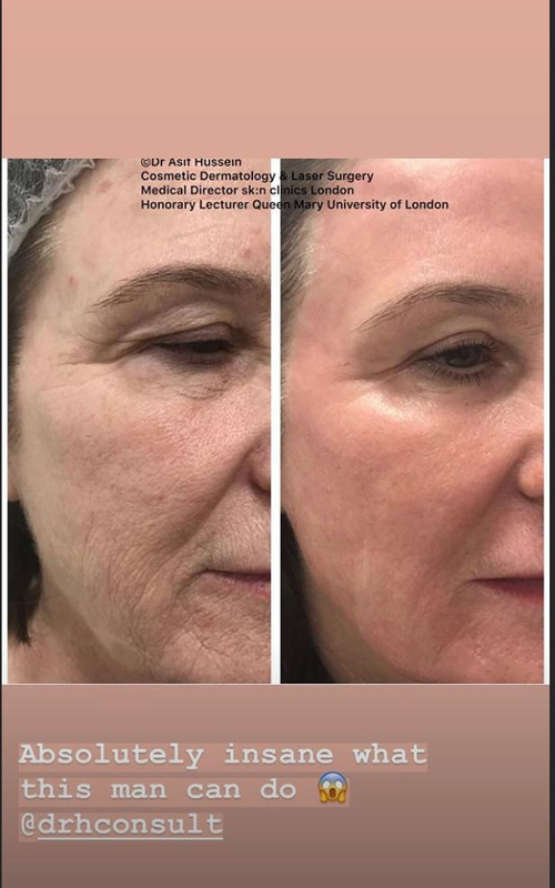 Fully Ablative CO2 Laser Resurfacing Treatment