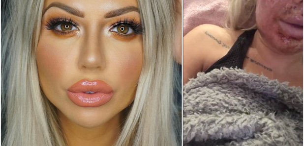 Holly Hagan laser treatment